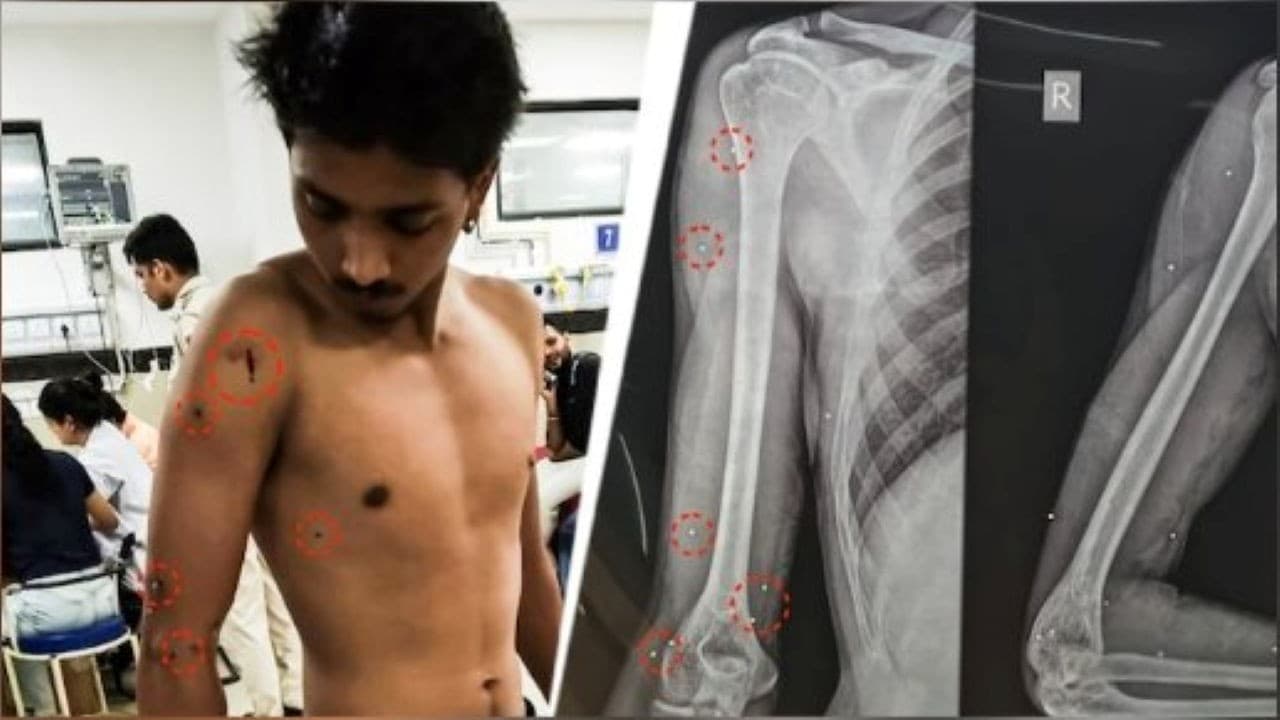 पेंटर प्रशांत की दर्दनाक दास्तान- जंतर मंतर पर पैलेट गन से 5 नहीं, 6 लोग घायल हुए पेंटर प्रशांत की दर्दनाक दास्तान- जंतर मंतर पर पैलेट गन से 5 नहीं, 6 लोग घायल हुए